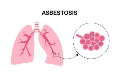 Asbestosis anatomik poster. Akciğer hastalığı konsepti, asbest lifleri. Akciğer dokusu yaralanması, nefes darlığı, göğüs ağrısı. Solunum problemi, solunum sistemi vektör çizimi hastalığı.
