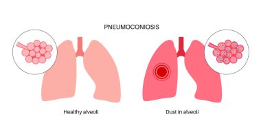 Pnömokonyoz, asbestoz ve silikoz. Kömür işçileri hastalığı, CWP veya kara akciğer mesleki hastalığı, solunum sisteminde kömür madeni tozu veya asbest. Nefes darlığı, göğüs ağrısı vektörü