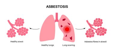 Asbestosis anatomik poster. Akciğer hastalığı konsepti, asbest lifleri. Akciğer dokusu yaralanması, nefes darlığı, göğüs ağrısı. Solunum problemi, solunum sistemi vektör çizimi hastalığı.