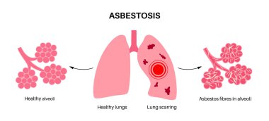 Asbestosis anatomical poster. Lung disease concept, asbestos fibers. Lung tissue scarring and shortness of breath, pain in chest. Breathing problem, illness of respiratory system vector illustration. clipart