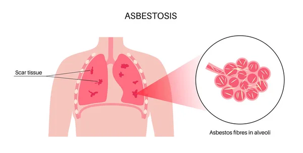 Afiche Anatómico Asbestosis Concepto Enfermedad Pulmonar Fibras Asbesto Cicatrización Del — Vector de stock