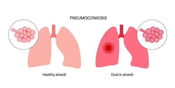 Neumoconiosis Asbestosis Silicosis Enfermedad Los Trabajadores Del Carbón Cwp Enfermedad — Vector de stock