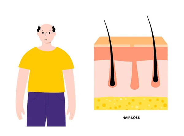 Hair Loss Problems Treatment Cartoon Man Character Balding Head Skin — Stock Vector