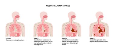 Lung cancer stages, mesothelioma tumor cells spreading. Respiratory system illness. Asbestos related diseases. Shortness of breath, pain in chest, breathing problem, medical flat vector illustration. clipart