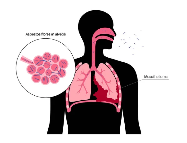 Mesothelioma腫瘍細胞ポスター 肺癌の概念 呼吸器系疾患 アスベスト関連疾患 息切れ 呼吸困難 医学フラットベクトルイラスト — ストックベクタ
