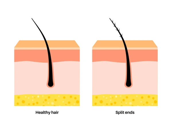 分头和发条海报 头部疾病和不健康的头发概念 温度对头发的影响 表皮图 真皮和真皮下 扁平载体图解 — 图库矢量图片