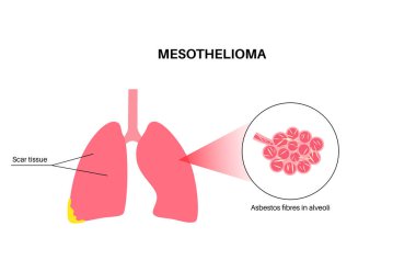 Mezotelyom tümör hücreleri posteri. Akciğer kanseri konsepti. Solunum sistemi hastalığı. Asbest kaynaklı hastalıklar. Nefes darlığı, göğüs ağrısı, solunum problemi, tıbbi düz vektör çizimi.