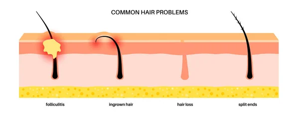 Συνηθισμένα Προβλήματα Μαλλιών Θυλακίτιδα Εντόσθια Μαλλιά Σπασμένες Άκρες Και Φαλάκρα — Διανυσματικό Αρχείο
