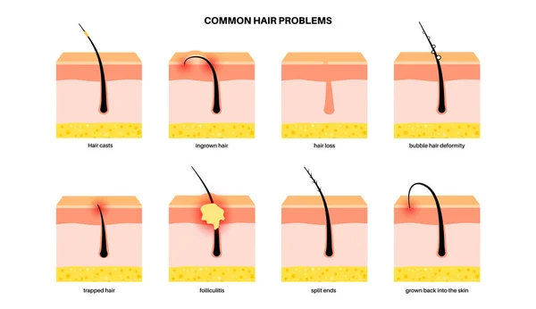 Masalah Umum Rambut Follikulitis Rambut Tumbuh Ujung Terbelah Dan Kebotakan - Stok Vektor
