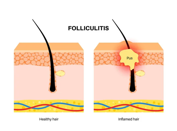 毛囊炎医疗海报 带有细菌或感染的发炎的毛囊 毛囊中带有脓汁的粉刺 痛和疼痛的地方 表皮图 真皮载体图解 — 图库矢量图片