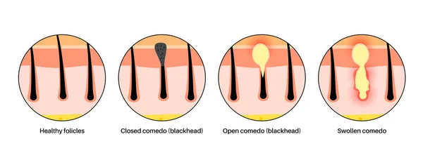 Acne Treatment Blackheads Whiteheads Closed Inflamed Comedo Dead Cells Oil — Stock Vector