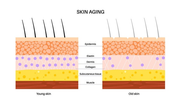 Skin aging concept. Young and old skin comparison, elastane and collagen components. Skin changes with age. Wrinkles on the body over time. Epidermis, dermis and hypodermis flat vector illustration.