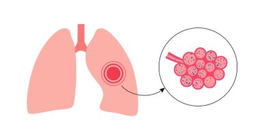 Pnömokonyoz, asbestoz ve silikoz. Kömür işçileri hastalığı, CWP veya kara akciğer mesleki hastalığı, solunum sisteminde kömür madeni tozu veya asbest. Nefes darlığı, göğüs ağrısı vektörü