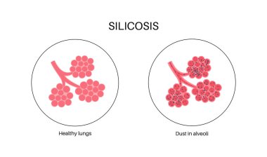 Silikozis anatomik poster. Akciğer hastalığı, yüksek miktarda kristal silis tozu soluyor. Nefes darlığı, göğüs ağrısı. Solunum problemi, solunum sistemi vektör çizimi hastalığı.