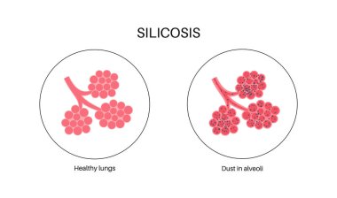Silicosis anatomical poster. Lung disease, inhaling large amounts of crystalline silica dust. Shortness of breath, chest pain. Breathing problem, illness of respiratory system vector illustration. clipart
