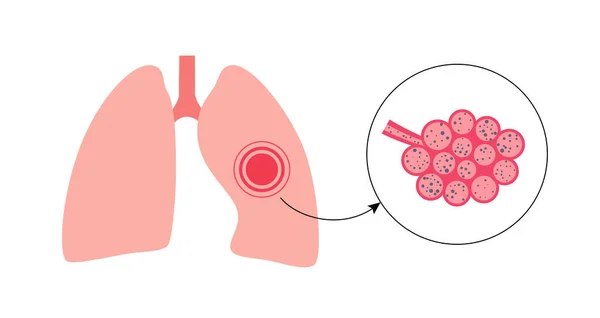 Pneumoconiosis Azbeszt Szilikózis Szénmunkások Betegsége Cwp Vagy Fekete Tüdő Foglalkozási — Stock Vector
