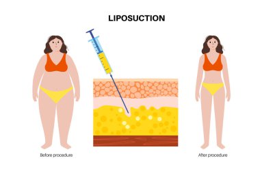 Ameliyattan önce ve sonra liposuction ameliyatı, siluet. Obez vücuttaki yağı temizle. Obezite problemi. Aşırı kilolu kavramı. Deri katmanları, üst deri yapısı, deri ve deri altı vektör çizimi