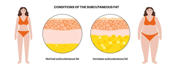 Fetma Koncept Överflödigt Fett Kvinnlig Människokropp Celluliter Och Öka Subkutant — Stock vektor