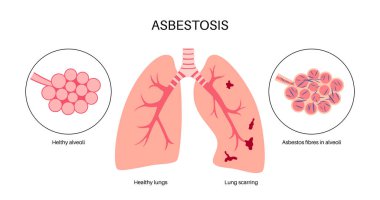Asbestosis anatomik poster. Akciğer hastalığı konsepti, asbest lifleri. Akciğer dokusu yaralanması, nefes darlığı, göğüs ağrısı. Solunum problemi, solunum sistemi vektör çizimi hastalığı.