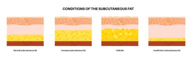 Conditions of the subcutaneous fat in the human body. Cellulite concept, excess and insufficient fat diagram. Diet program. Skin layers structure epidermis, dermis and hypodermis vector illustration clipart