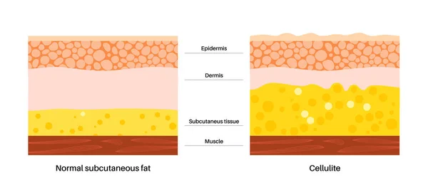 Cellulitis Concept Overtollig Vet Het Menselijk Lichaam Overgewicht Verhoging Subcutaan — Stockvector