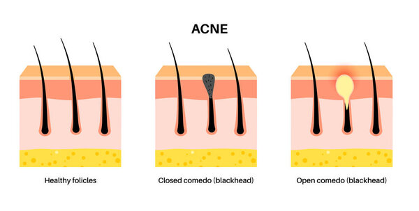 Acne treatment. Blackheads and whiteheads, closed and inflamed comedo. Dead cells and oil from the skin clog hair follicles. Skin layers diagram, epidermis, dermis and hypodermis vector illustration.