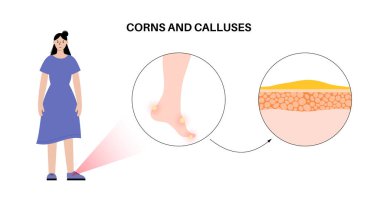 Nasır tıp posteri. İnsan ayağında pürüzlü, kalınlaşmış bir deri parçası. Dermatoloji kliniği afişi şişmiş derisi ve acı dolu nasırları var. Epidermis düzeyi düz vektör illüstrasyonundaki ölü hücreler