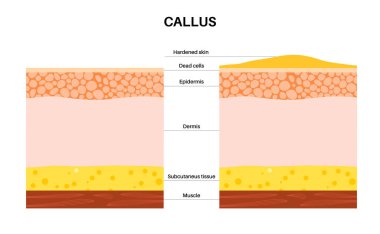 Nasır tıp posteri. İnsan ayağında pürüzlü, kalınlaşmış bir deri parçası. Dermatoloji kliniği afişi şişmiş derisi ve acı dolu nasırları var. Epidermis düzeyi düz vektör illüstrasyonundaki ölü hücreler