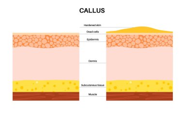 Callus medical poster. Rough, thickened area of skin on the human feet. Dermatology clinic banner with swollen skin and painful round corns. Dead cells on epidermis level flat vector illustration clipart