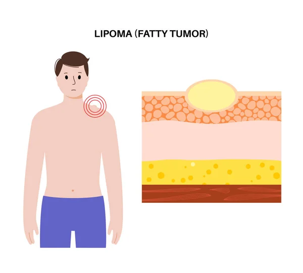 Lipom Fett Tumör Medicinsk Affisch Inte Cancer Godartad Tumör Huden — Stock vektor