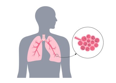Pnömokonyoz, asbestoz ve silikoz. Kömür işçileri hastalığı, CWP veya kara akciğer mesleki hastalığı, solunum sisteminde kömür madeni tozu veya asbest. Nefes darlığı, göğüs ağrısı vektörü