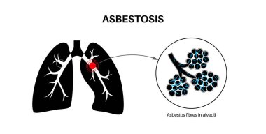Asbestosis anatomik poster. Akciğer hastalığı konsepti, asbest lifleri. Akciğer dokusu yaralanması, nefes darlığı, göğüs ağrısı. Solunum problemi, solunum sistemi vektör çizimi hastalığı.