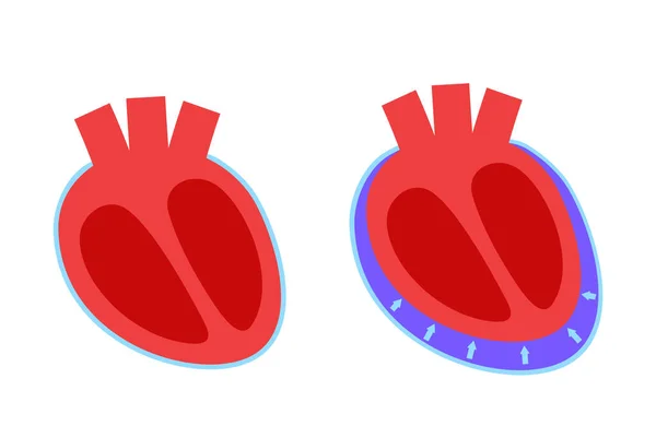 周期的融合ポスター 心臓の周りの空間で流体 心臓タンポナーデ原因 炎症を起こした内臓 人体への感染 心血管系医療ベクトル図 — ストックベクタ