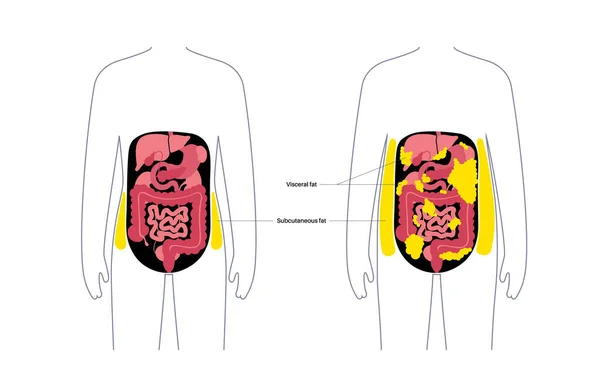 Медицинский Плакат Висцеральным Жиром Жир Живота Окружает Внутренние Органы Брюшной — стоковый вектор