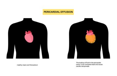 Perikardiyal efüzyon posteri. Kalbin etrafındaki boşlukta sıvı, kardiyak tamponad. İltihaplı iç organlar, insan vücudunda enfeksiyon. Kardiyovasküler sistem tıbbi vektör çizimi