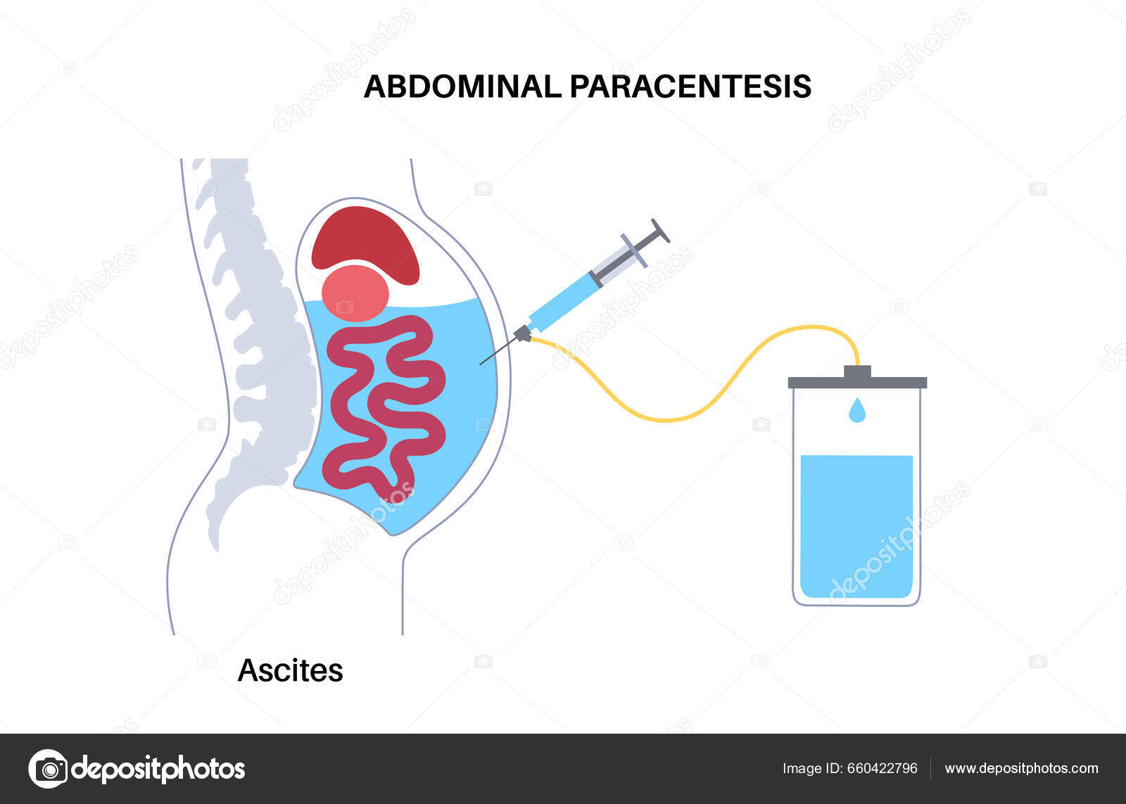 Abdominal Paracentesis Procedure Fluid Abdomen Drain Ascitic Fluid