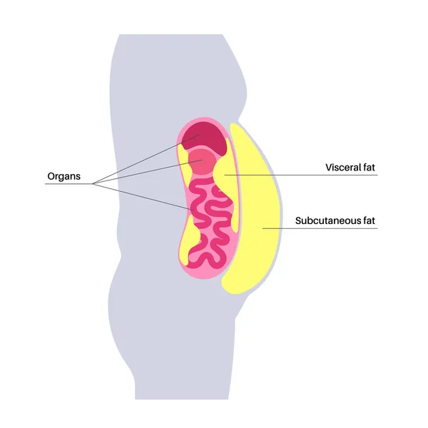Вісцеральний Жирний Медичний Плакат Жир Оточує Внутрішні Органи Черевної Порожнини — стоковий вектор