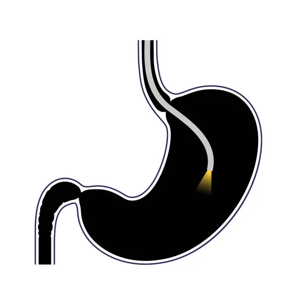 Procedimiento Gastroscopia Gastroenterólogo Usa Gastroscopio Diagnóstico Estómago Duodeno Gastroenterología Endoscopia — Vector de stock