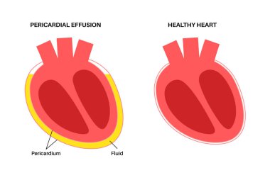 Pericardial effusion poster. Fluid in the space around the heart, cardiac tamponade cause. Inflamed internal organs, infection in the human body. Cardiovascular system medical vector illustration clipart