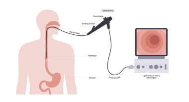 Gastroskopi prosedürü. Gastroenterolog gastroskop kullanıyor. Endoskopi, klinikte mide teşhisi. Gastroenteroloji, gastrointestinal enfeksiyon. Sindirim sistemi hastalığı ve tedavi düz vektör