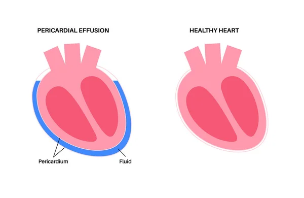 Cartaz Derrame Pericárdico Fluido Espaço Redor Coração Causa Tamponamento Cardíaco —  Vetores de Stock