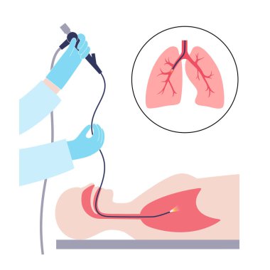 Bronkoskopi prosedürü. Pulmonolog ağızdan akciğere doğru bronkoskop kullanıyor. Solunum sistemi hastalıkları ve tedavisi. Endobronşiyal ultrason bronkoskopi tanısal vektör çizimi.