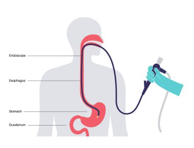 Gastroskopi prosedürü. Gastroenterolog gastroskop kullanıyor. Endoskopi, klinikte mide teşhisi. Gastroenteroloji, gastrointestinal enfeksiyon. Sindirim sistemi hastalığı ve tedavi düz vektör