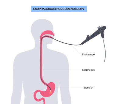 Gastroskopi prosedürü. Esophagogastroduodenoskopi konsepti. Endoskopi, klinikte mide teşhisi. Gastroenteroloji, gastrointestinal enfeksiyon. Sindirim sistemi hastalığı ve tedavi düz vektör