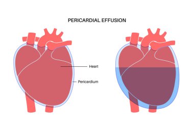 Perikardiyal efüzyon posteri. Kalbin etrafındaki boşlukta sıvı, kardiyak tamponad. İltihaplı iç organlar, insan vücudunda enfeksiyon. Kardiyovasküler sistem tıbbi vektör çizimi