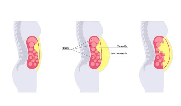 Viszeralfett Medizinisches Poster Bauchfett Umgibt Die Inneren Organe Bauchraum Krankheitskonzept — Stockvektor