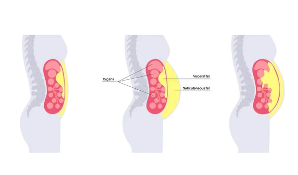 포스터 복부의 기관은 지방으로 둘러싸여 질병의 실루엣 — 스톡 벡터