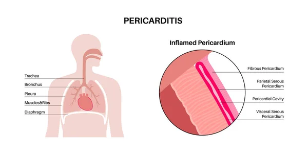 Pericarditis Anatómiai Poszter Szívfal Gyulladás Mellkasi Fájdalom Tünete Gyulladt Belső — Stock Vector