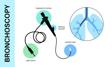 Bronkoskopi prosedürü. Pulmonolog nefes borusundan akciğere bronkoskop kullanıyor. Solunum sistemi hastalıkları ve tedavisi. Endobronşiyal ultrason bronkoskopi tanısal vektör çizimi