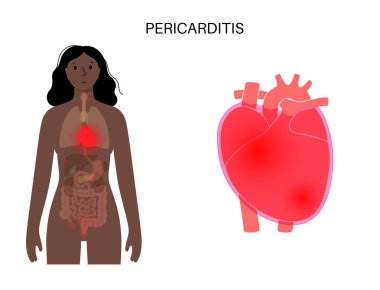 Perikardit anatomik poster. Kalp duvarı iltihabı. Göğüs ağrısı semptomu. İltihaplı iç organ konsepti. İnsan vücudunda viral enfeksiyon. Kardiyovasküler sistem medikal düz vektör çizimi